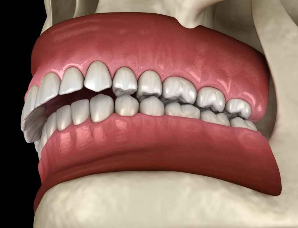Antalya jaw overbite