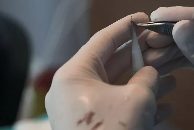 dhi hair transplant technique with choi implanter pen