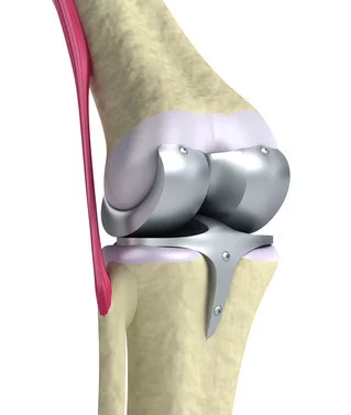 knee replacement surgery turkey