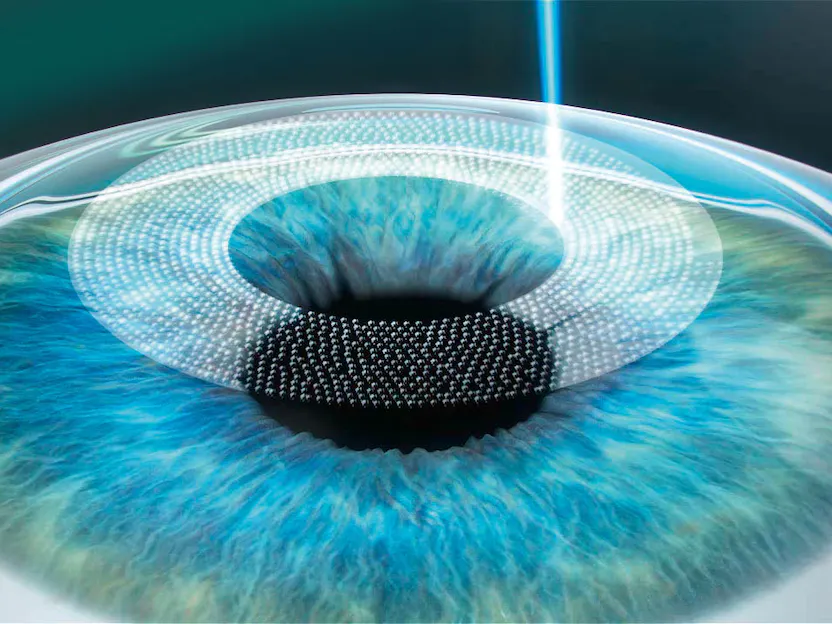 precautions during ilasik recovery from the eye laser