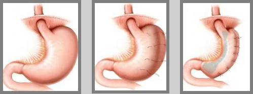 gastric plication also known as endoscopic sleeve gastroplasty