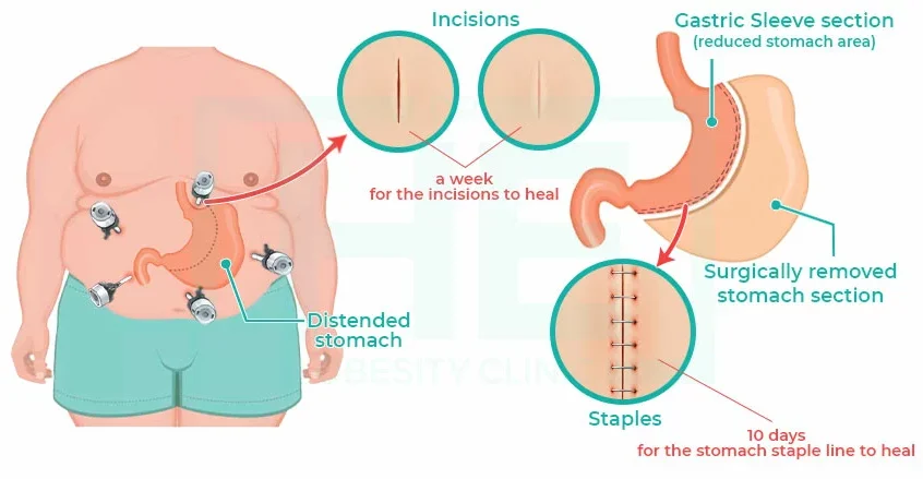Récupération après une chirurgie de l’obésité et incisions