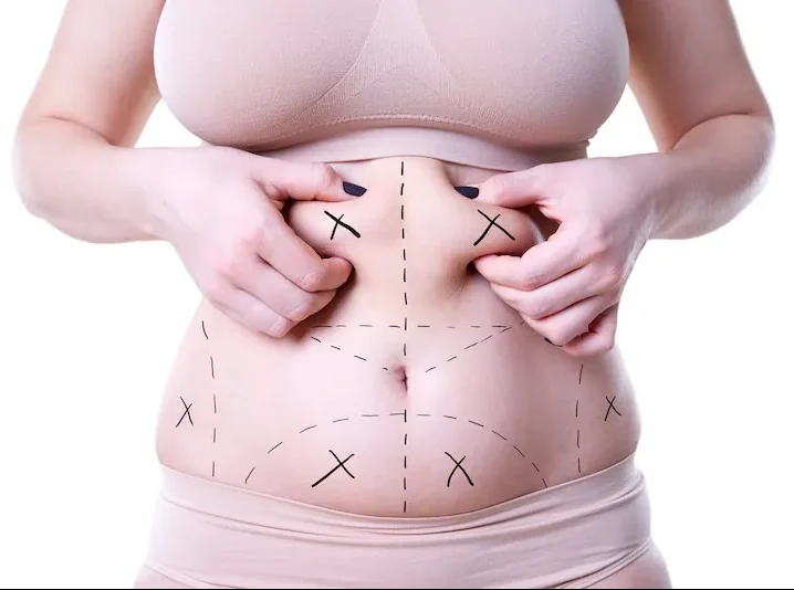 gastric bypass in antalya results