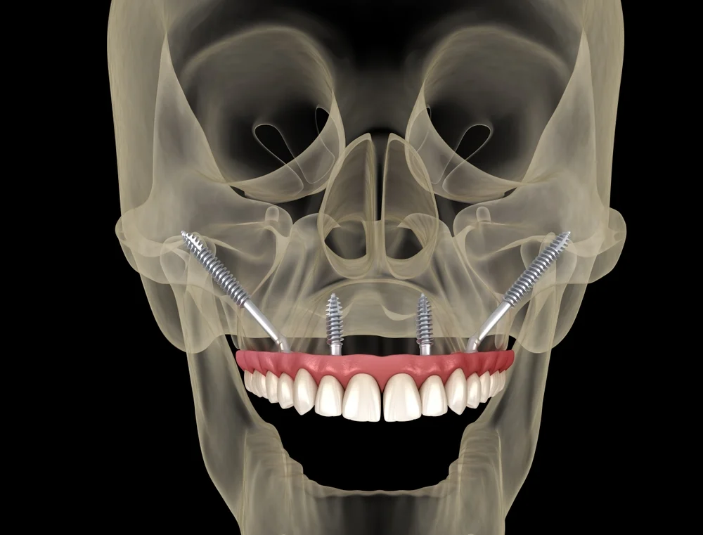 Zygoma-Ganzkieferimplantate