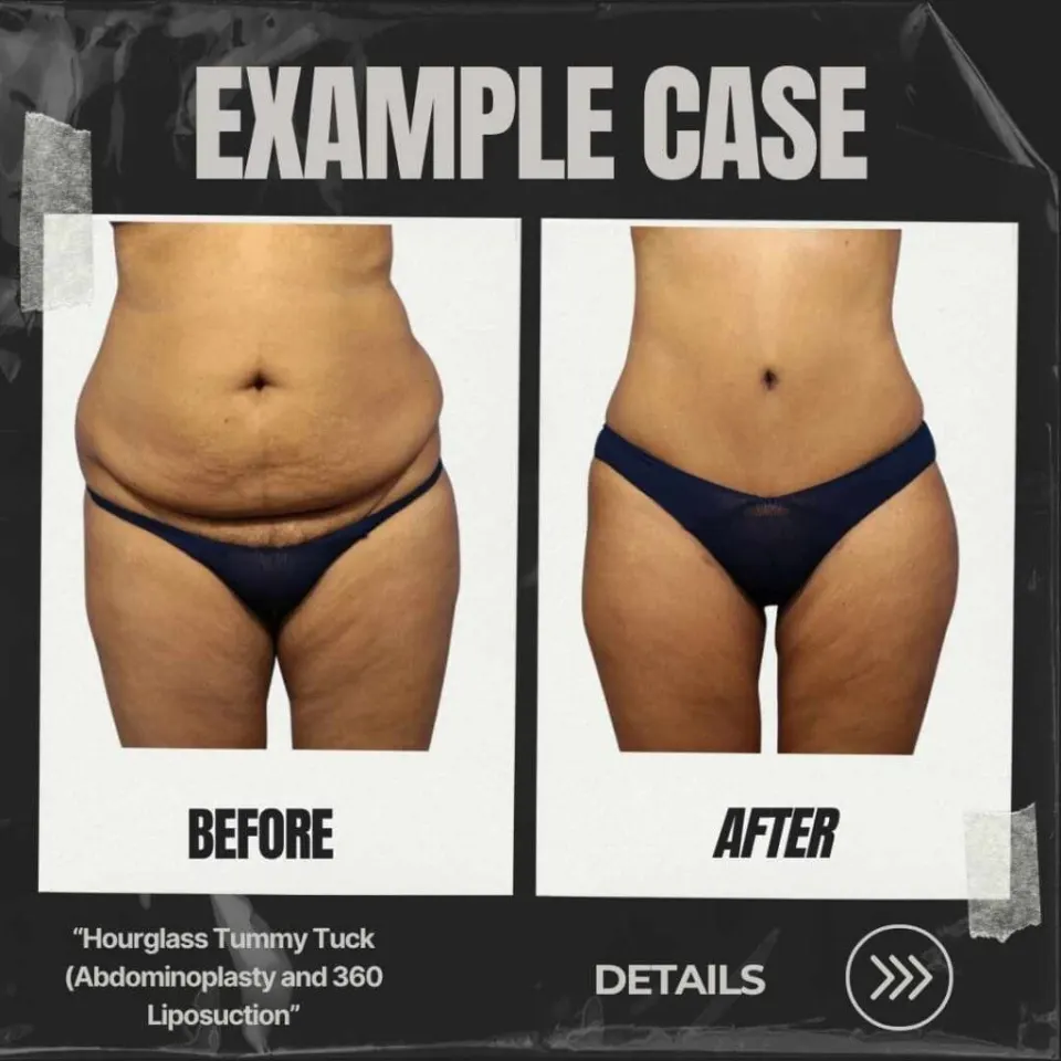 turkey reverse tummy tuck before and after