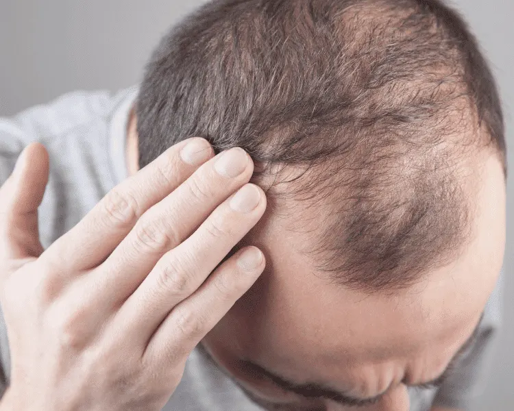 hair transplant candidate male