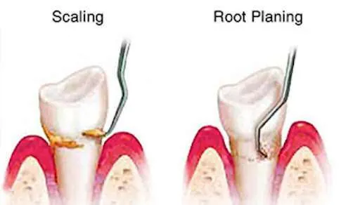 deep dental scaling and root planing