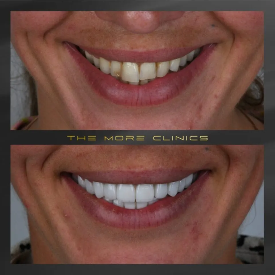 carillas dentales turkey antes y despues hollywood smile design