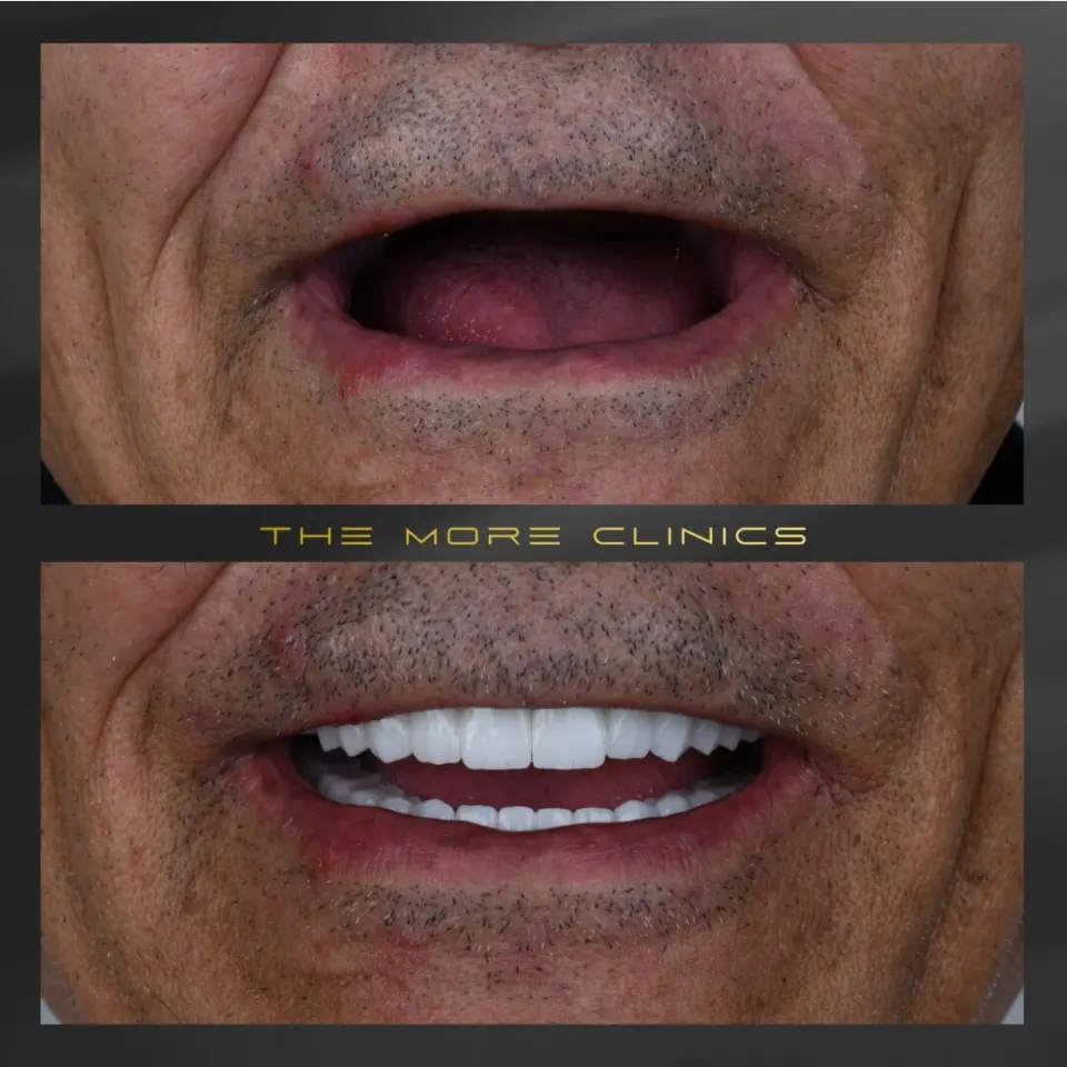 dental implants turkey as cheap options for missing teeth