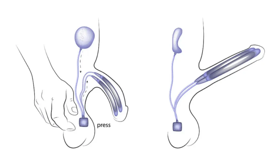 semi-rigid (malleable) penile implants