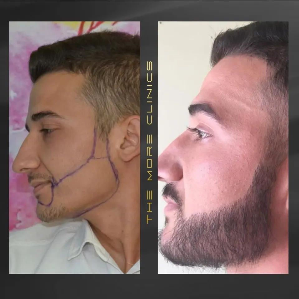 Hair before & after 30