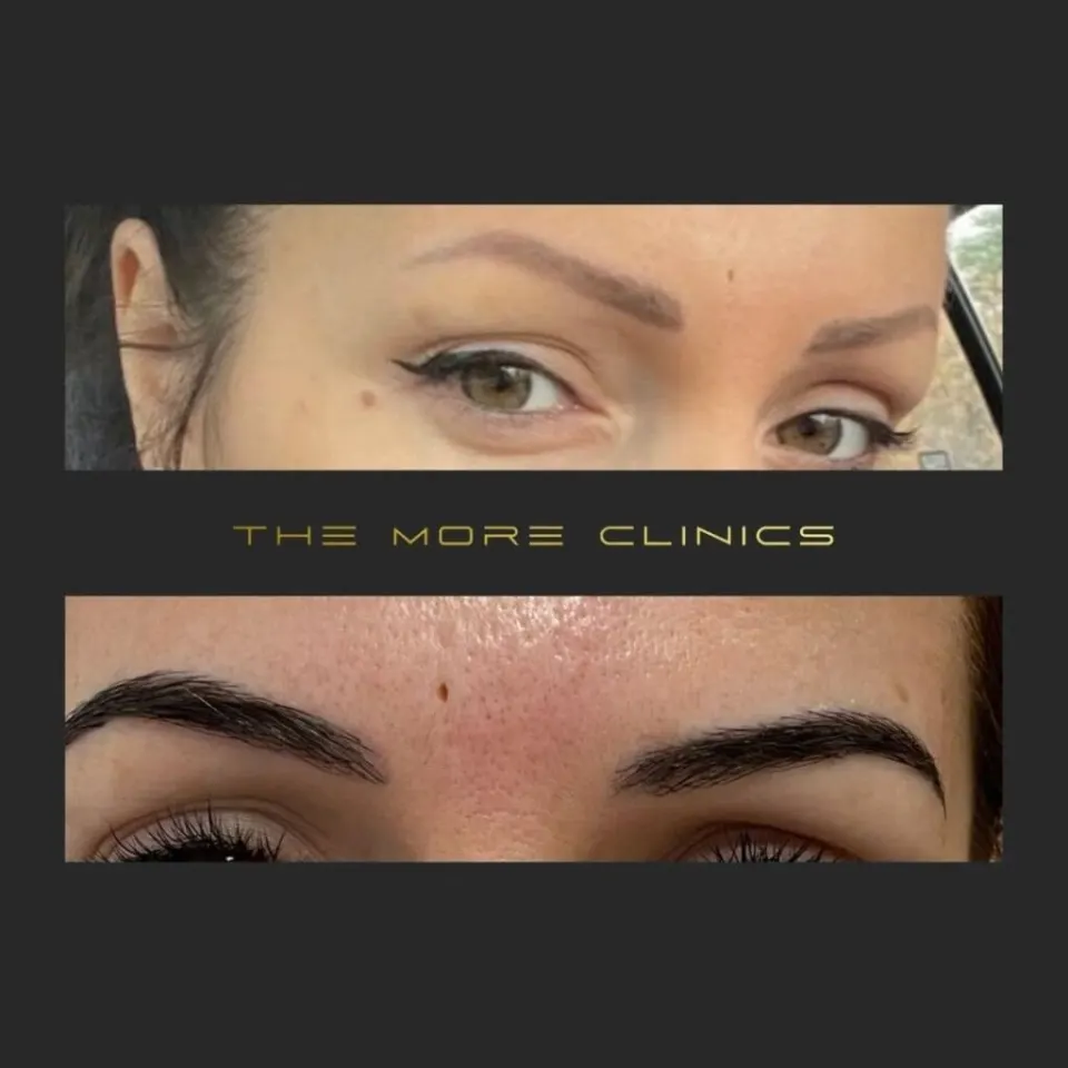 transplante de cejas turquía antalya antes después resultados