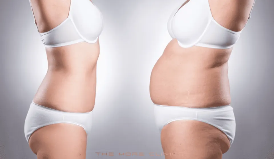 liposuction recovery timeline