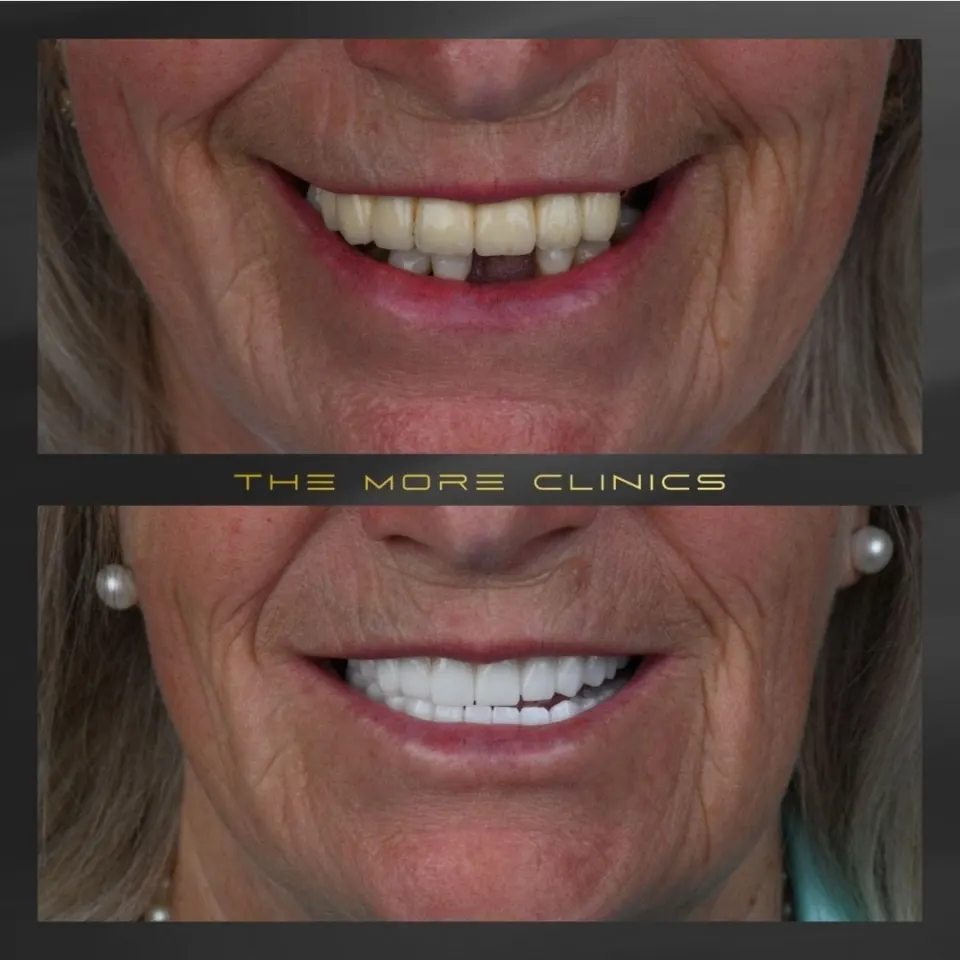 Dental before & after 23