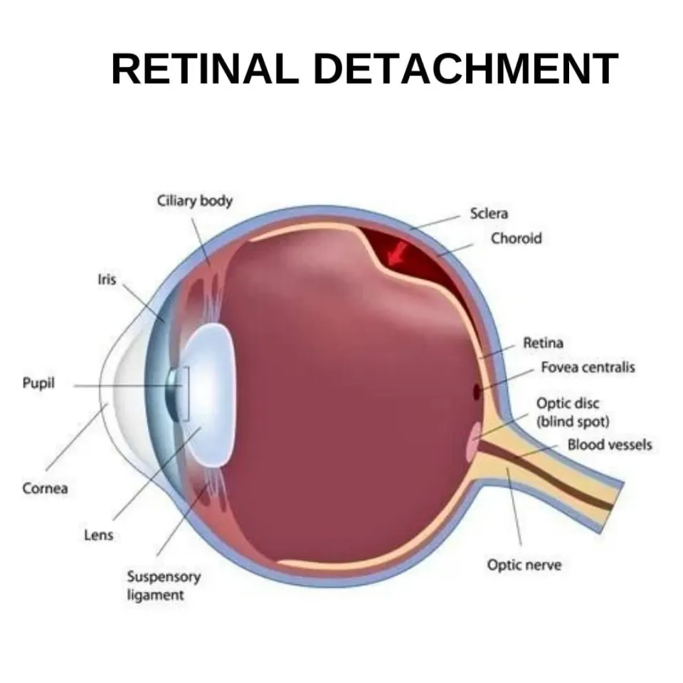 Rhegmatogenous retinal detachment