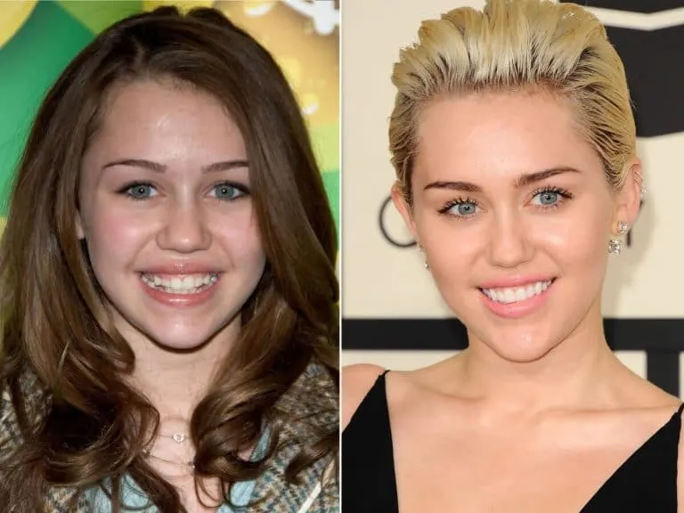miley cyrus teeth before and after