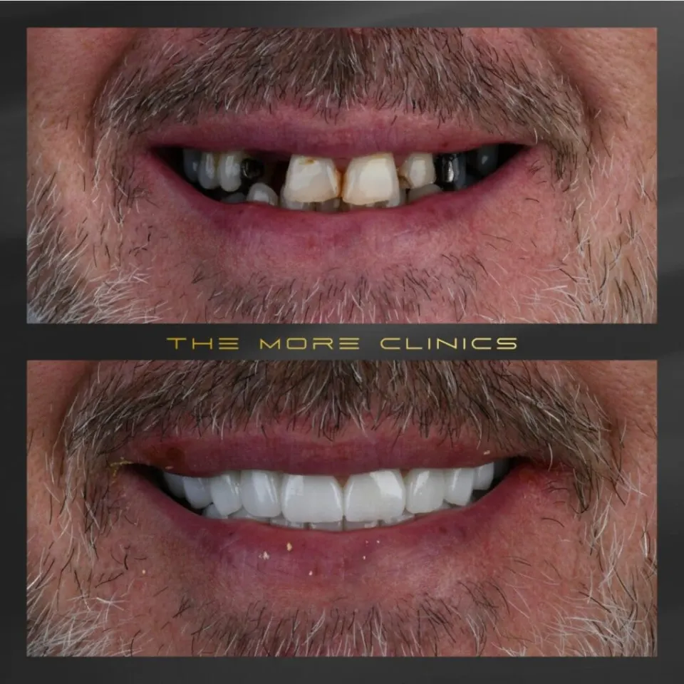 Front tooth zirconia crown before and after Turkey