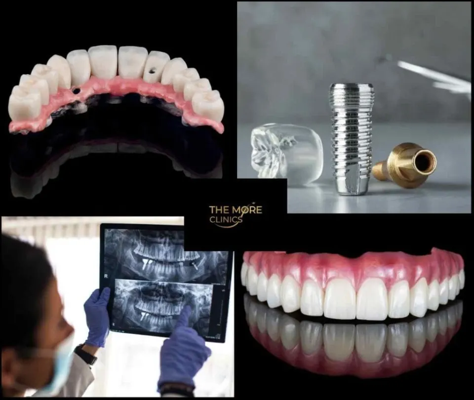 tipos de implantes dentales de arco completo pavo con el costo