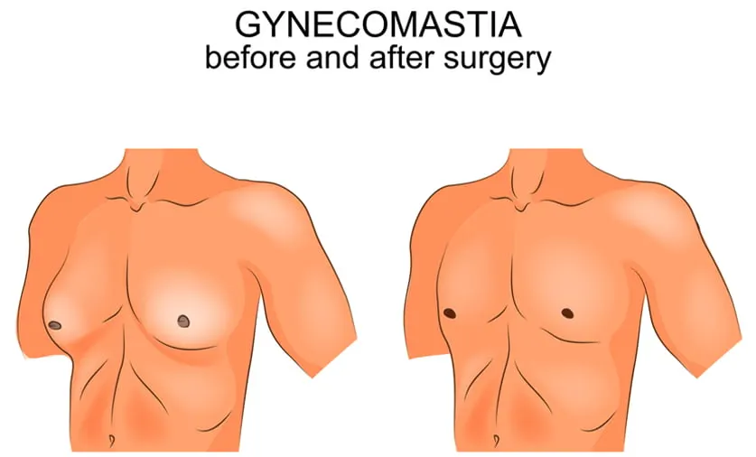 Male Mammoplasty - Gynecomasty
