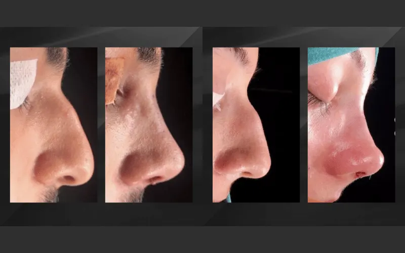 Antalya rhinoplasty turkey septoplasty before and after