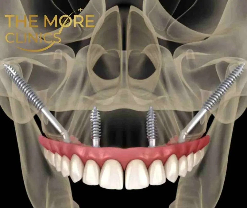 zygomatic implants turkey teeth