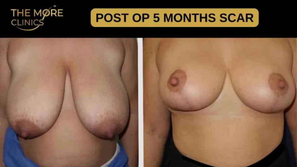 Healed Breast Reduction Scars on Light Skin -Abgeheilte Brustverkleinerungsnarben auf heller Haut