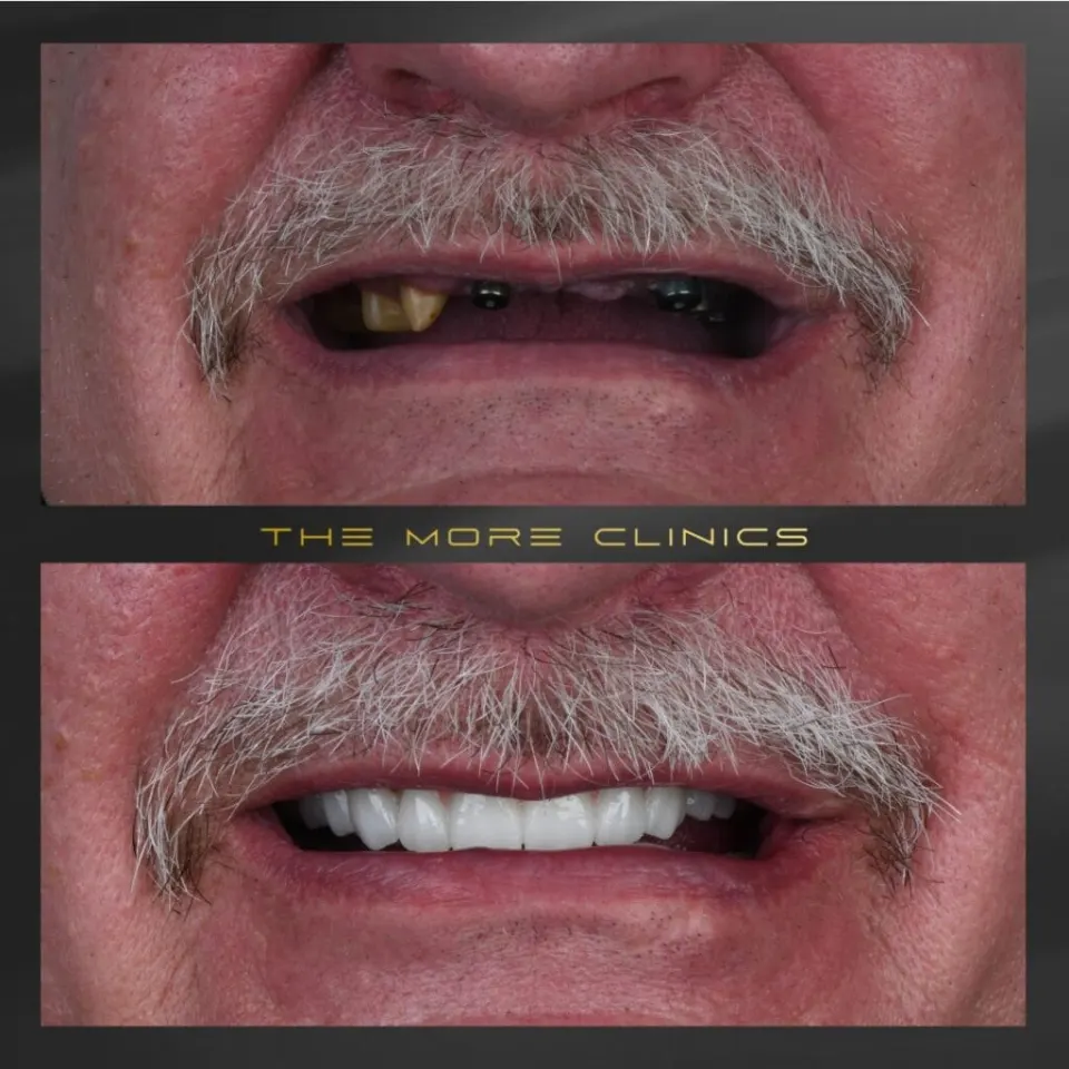 Tooth crown before and after results Turkey Antalya