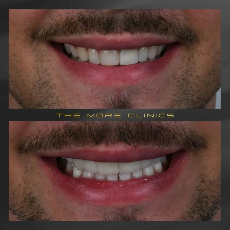 Dental before & after 35