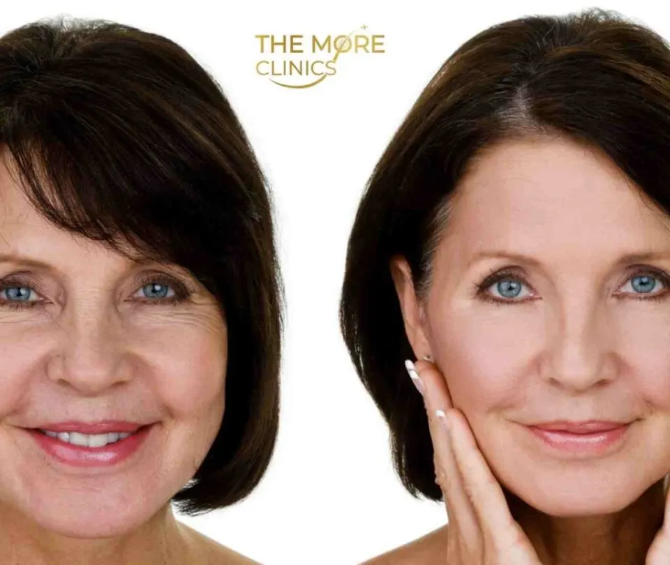 facelift vorher nachher türkei