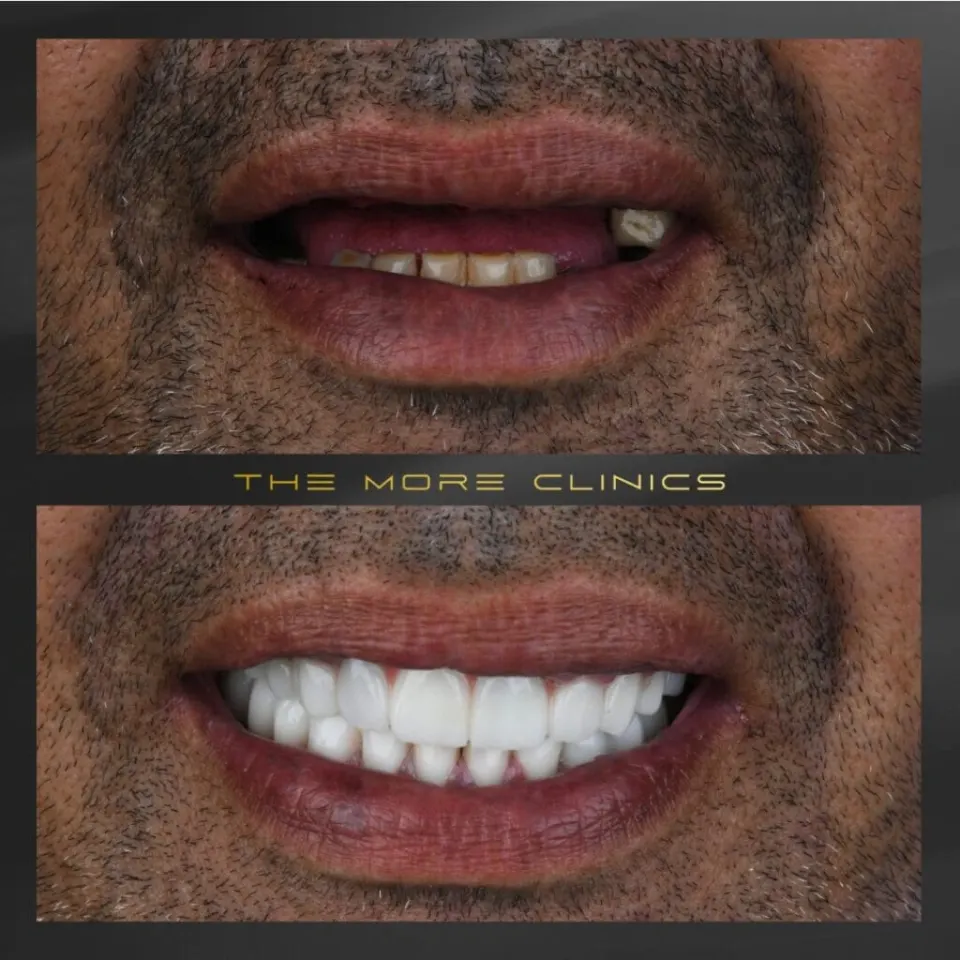 Tooth crown before and after — single crown restoration