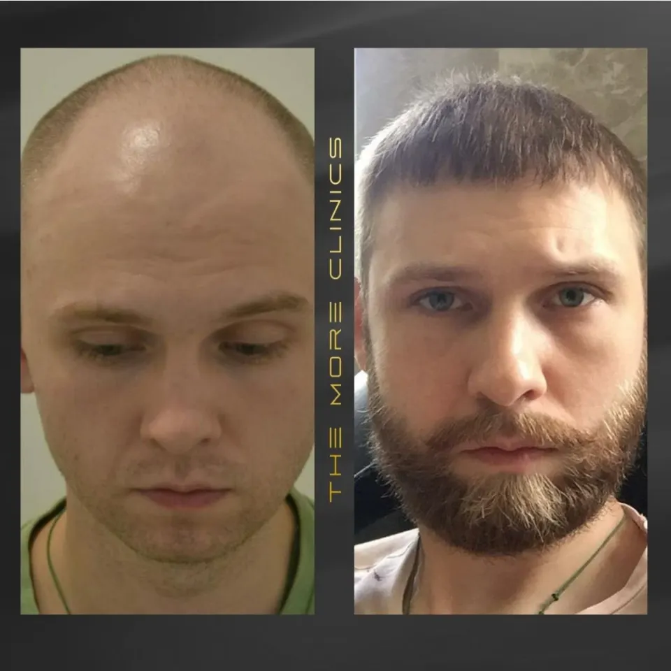 hair transplant in turkey before after