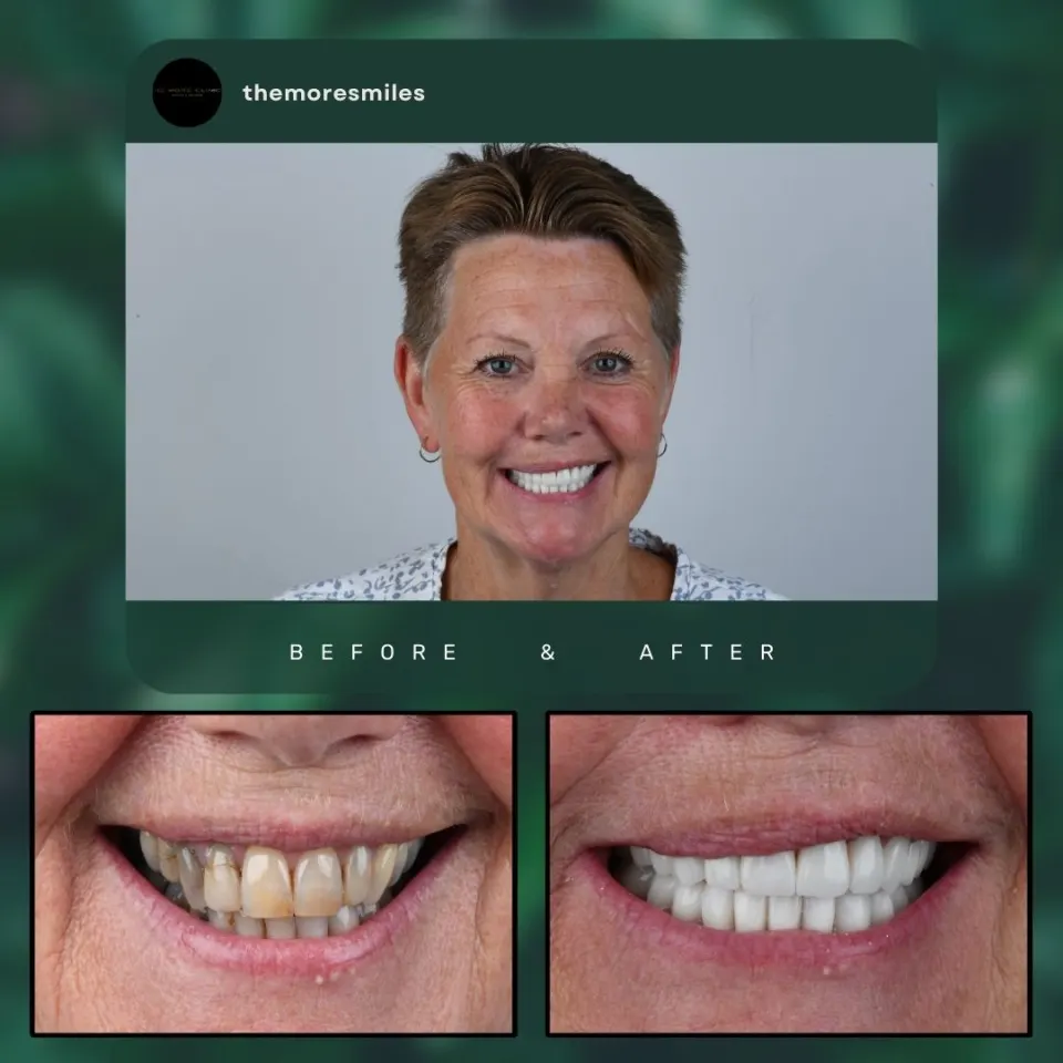 Dental before & after 51