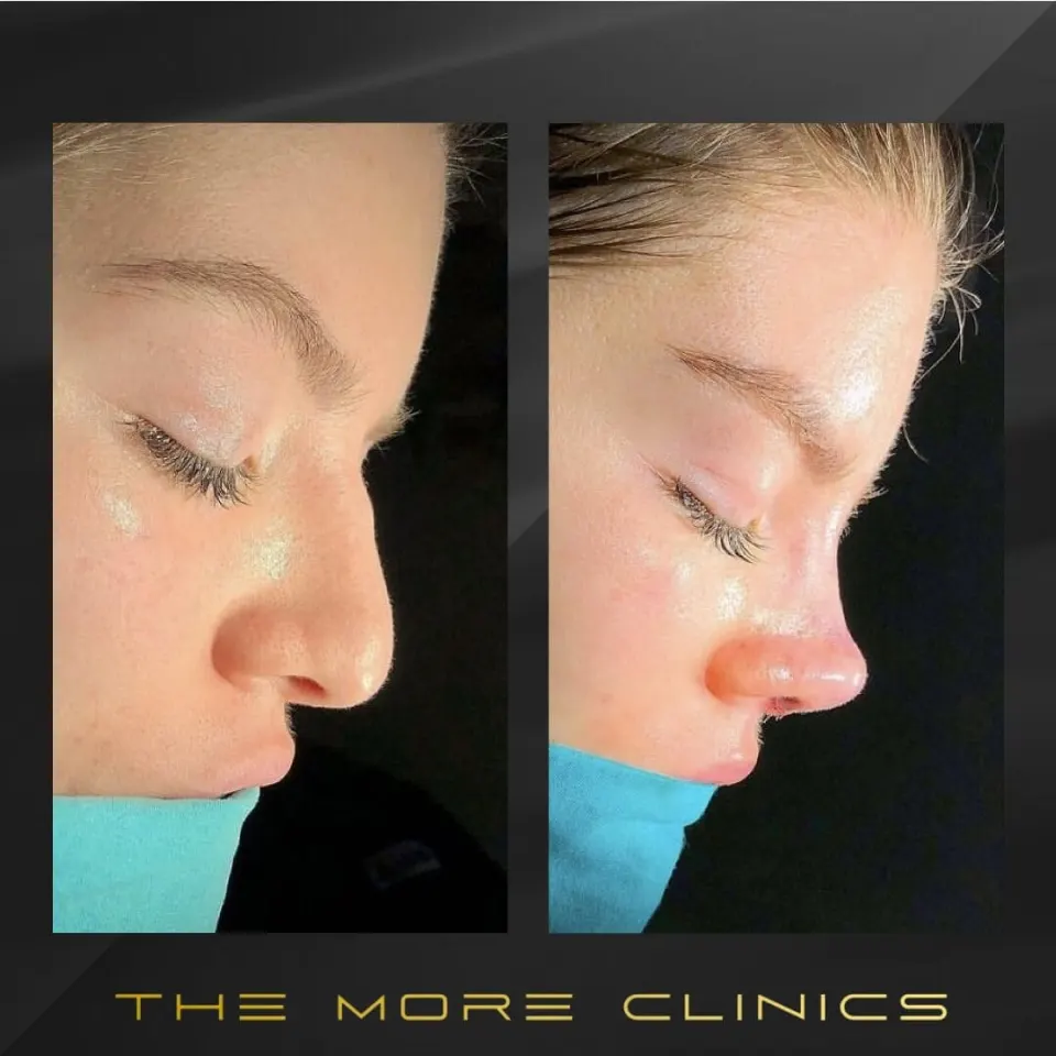 rhinoplasty before and after turkey