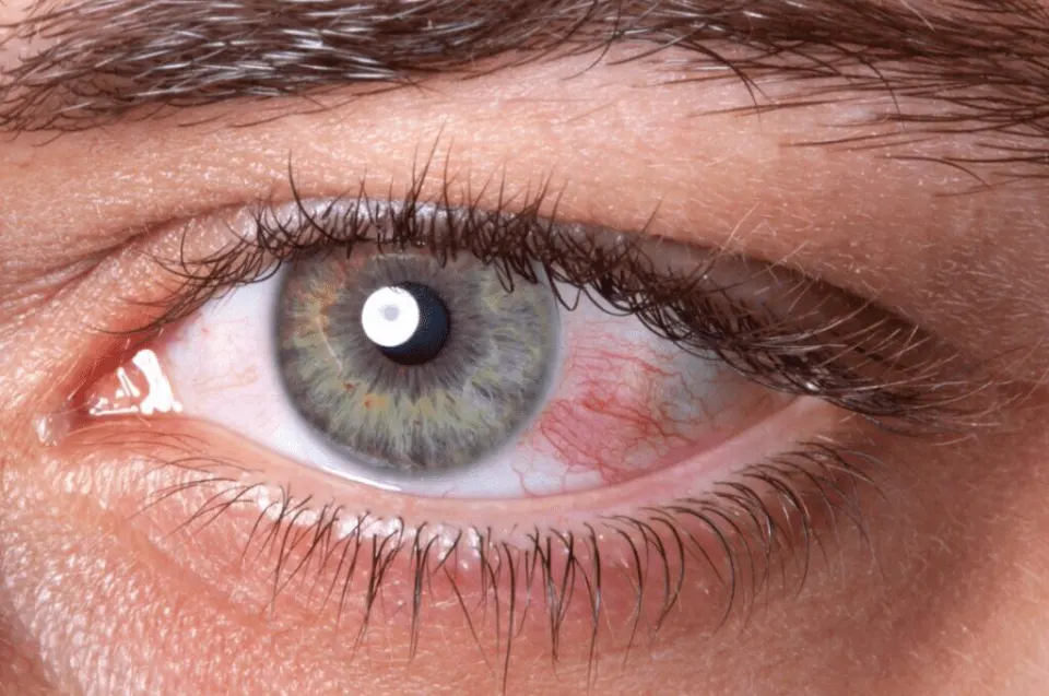 Antalya Laser Eye Surgery
