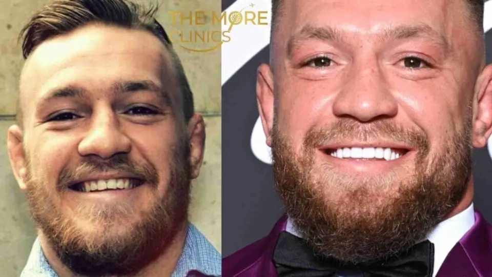 connor mcgregor before and after