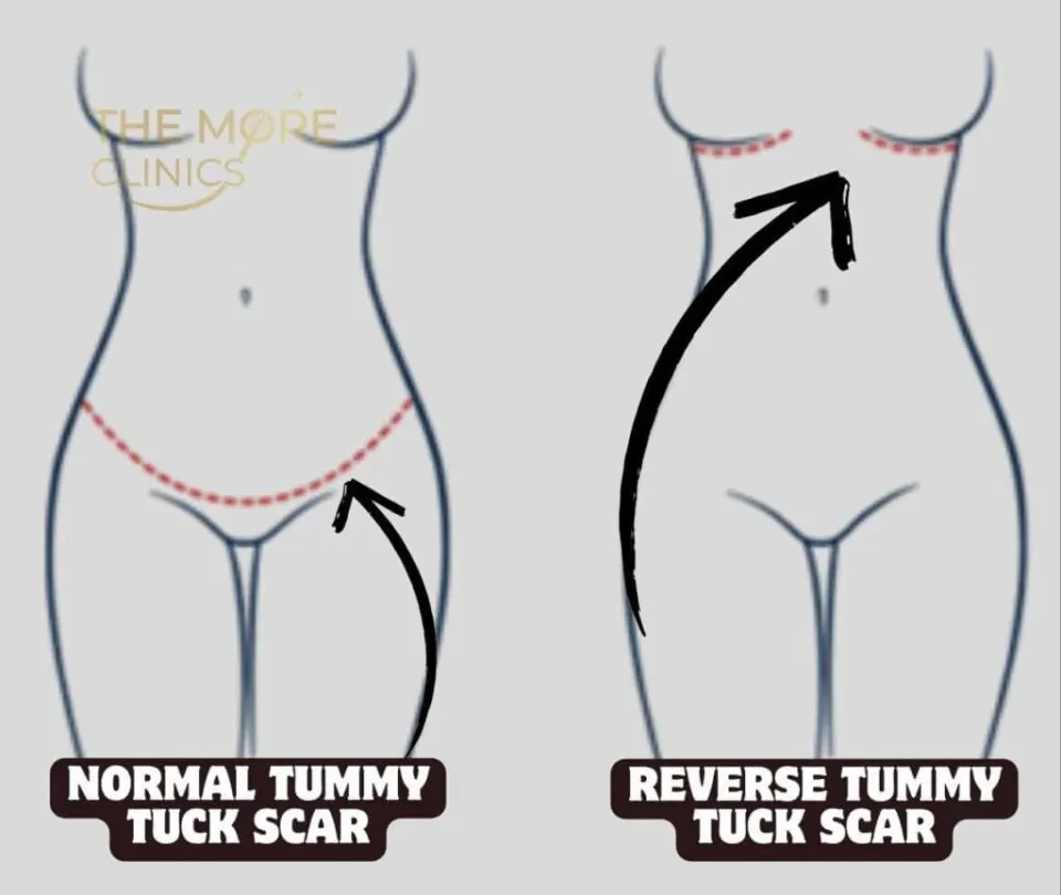 reverse tummy tuck scar vs normal tummy tuck scars