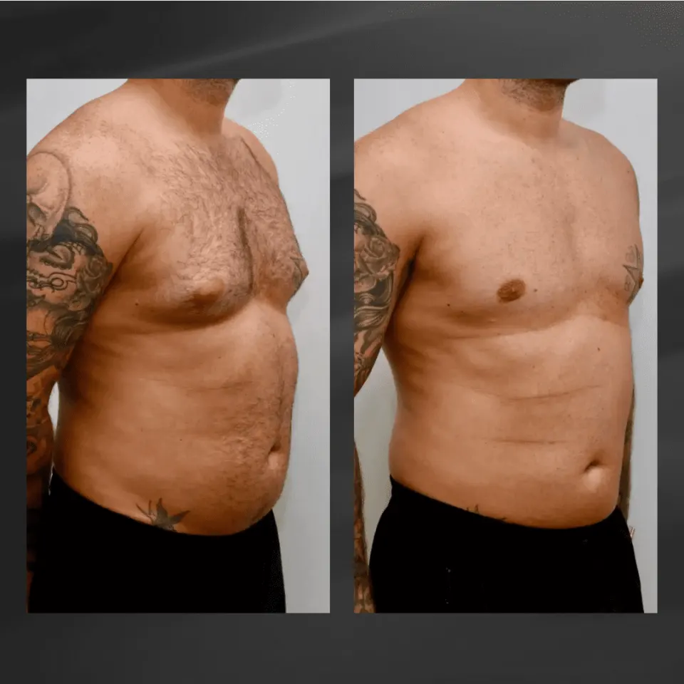 gynecomasty surgery before and after