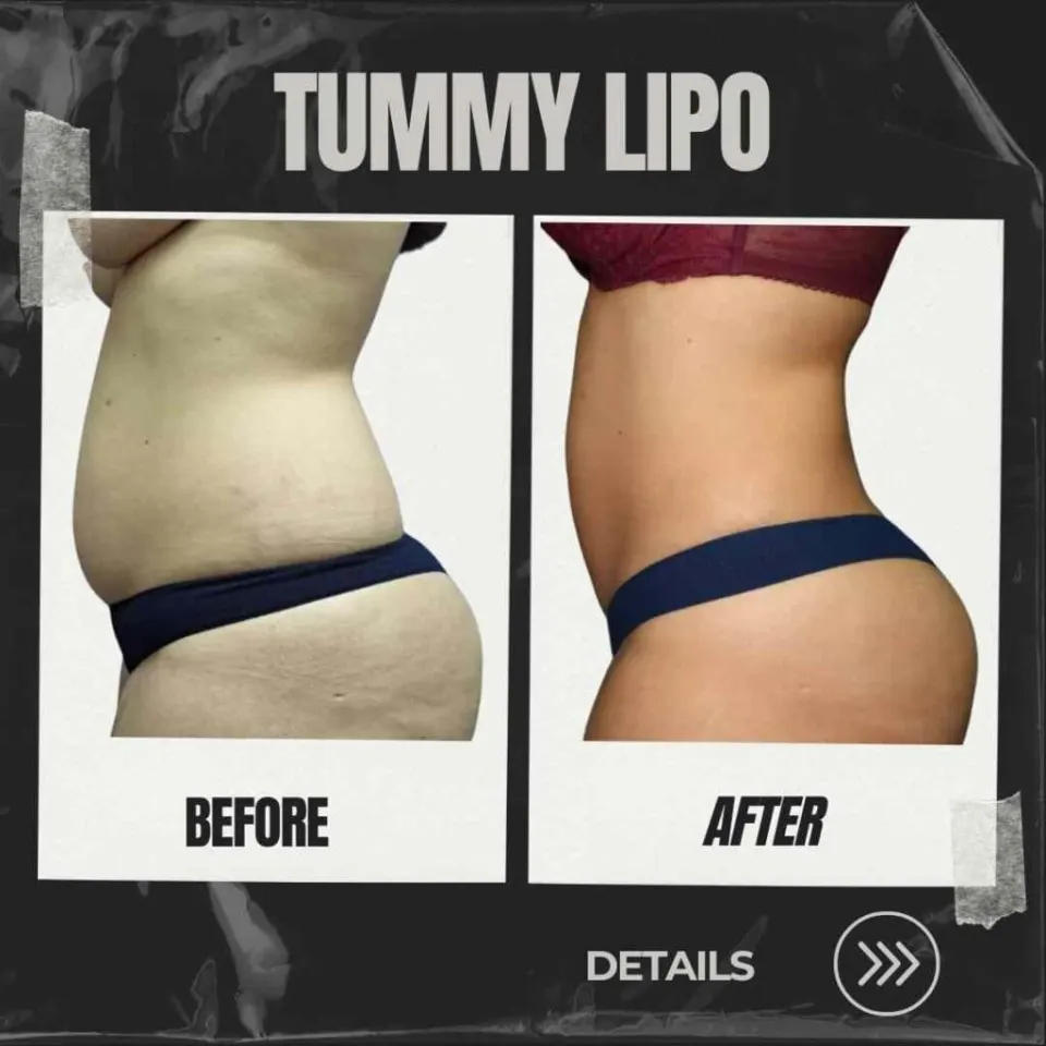 liposuktion fettabsaugung vorher-nachher bauch