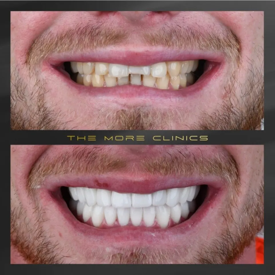 turkey teeth result wiht full mouth zirconium crowns