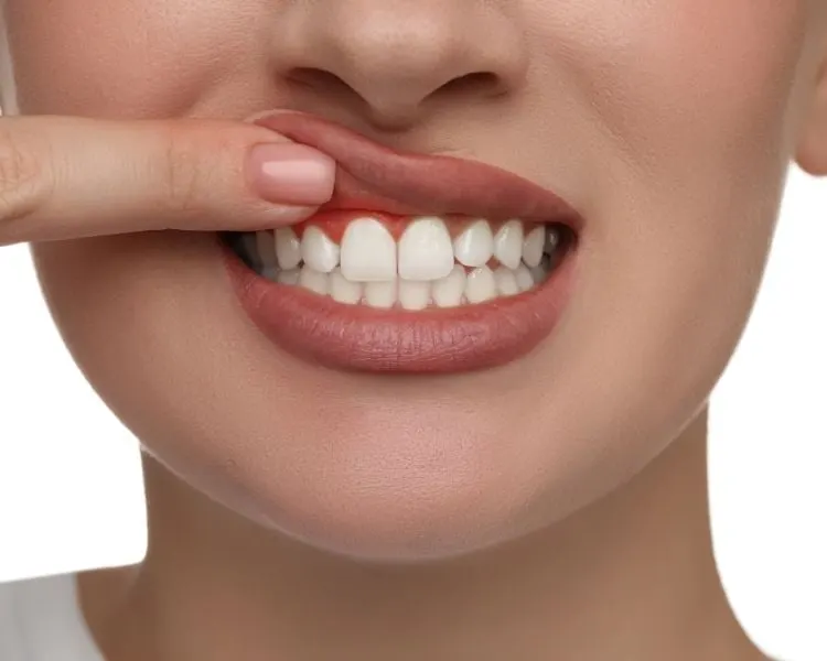 gingivitis Turkey