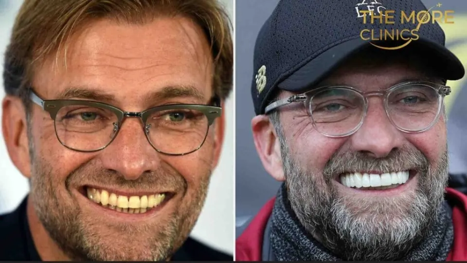 jurgen klopp teeth before and after