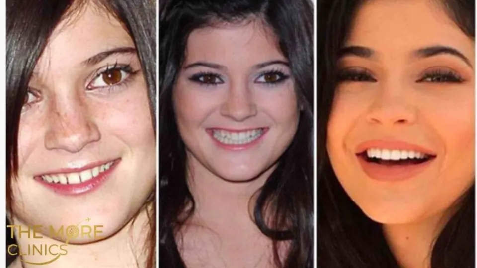kylie jenner teeth transformation celebrities with veneers