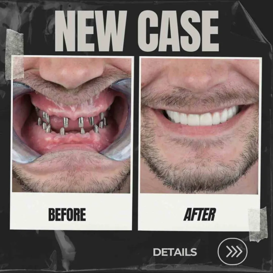 Full Mouth Dental Implants Turkey Package Deals Cost