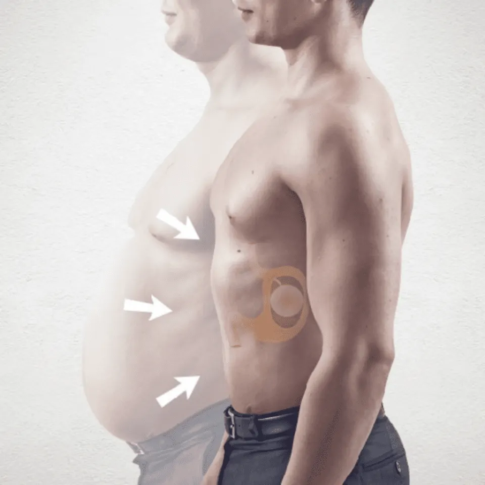 Antalya Swallowable Gastric Balloon