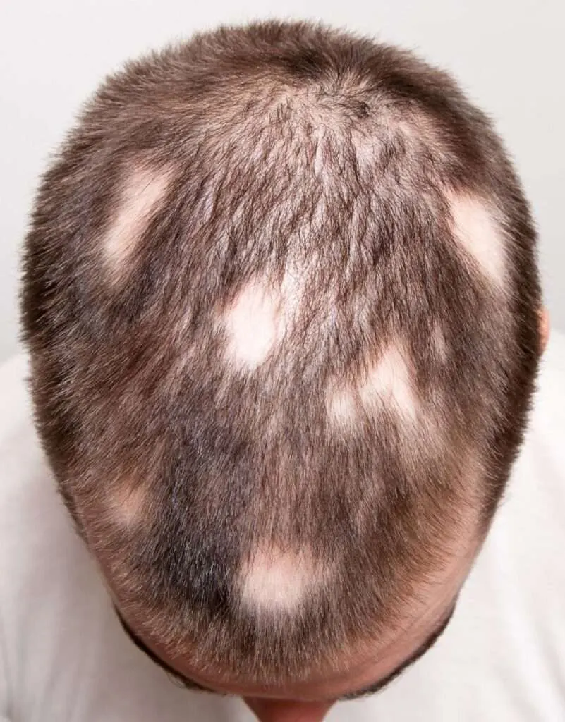 Antalya Alopecia Areata