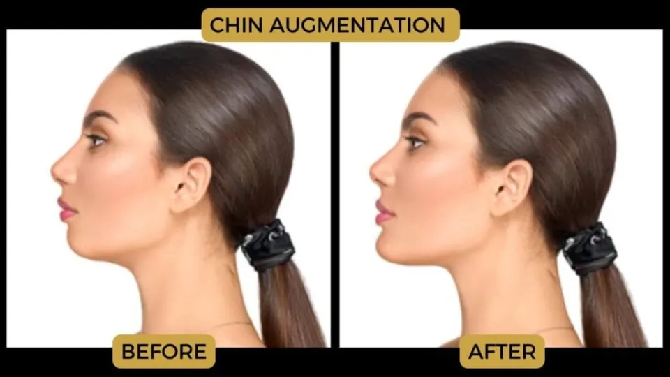 genioplasty before and after chin augmentation turkey