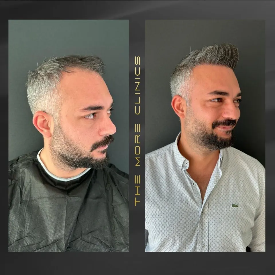 Hair-transplant results 5