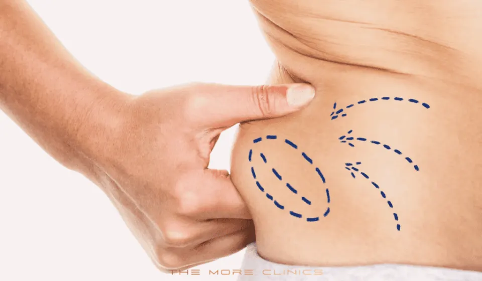 target areas for procedure