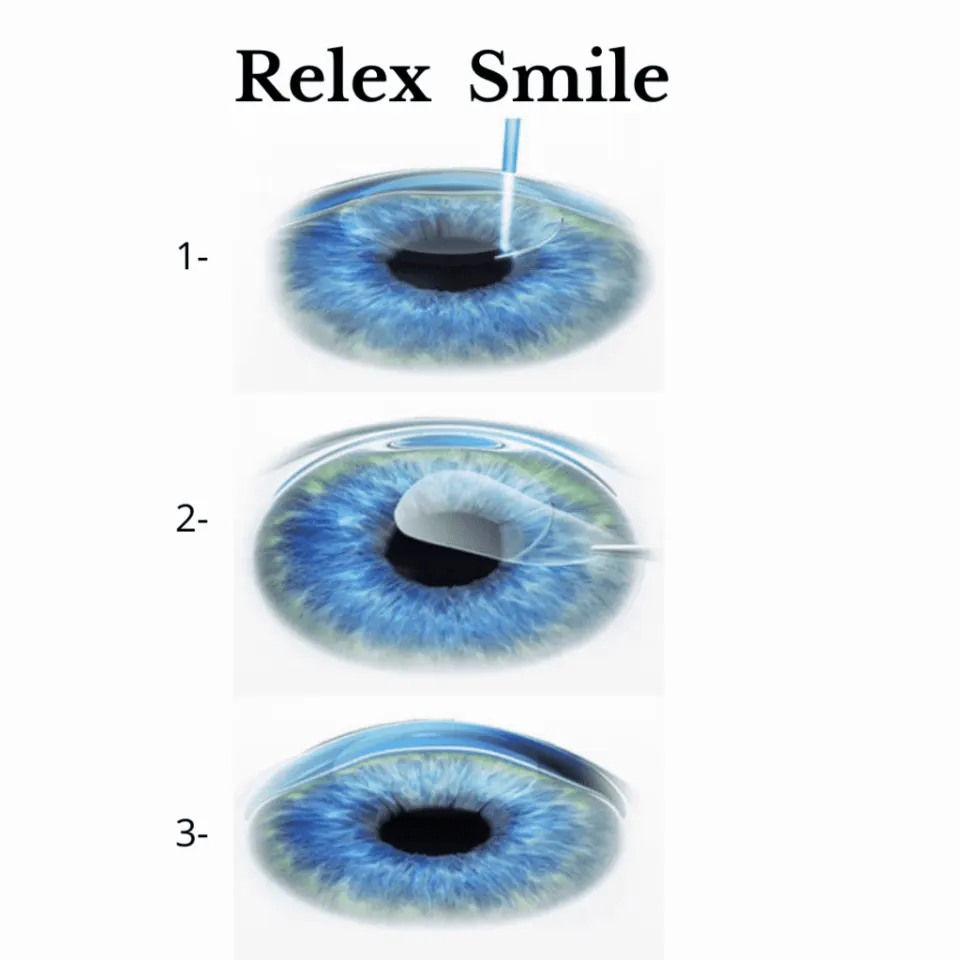 relex smile eye surgery
