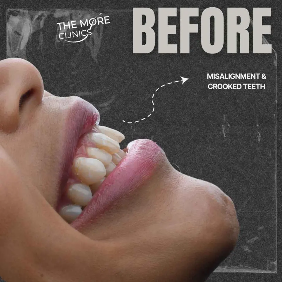 composite bonding teeth before and after